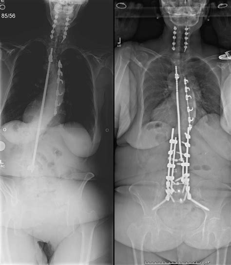 Harrington Rods | Scoliosis Texas