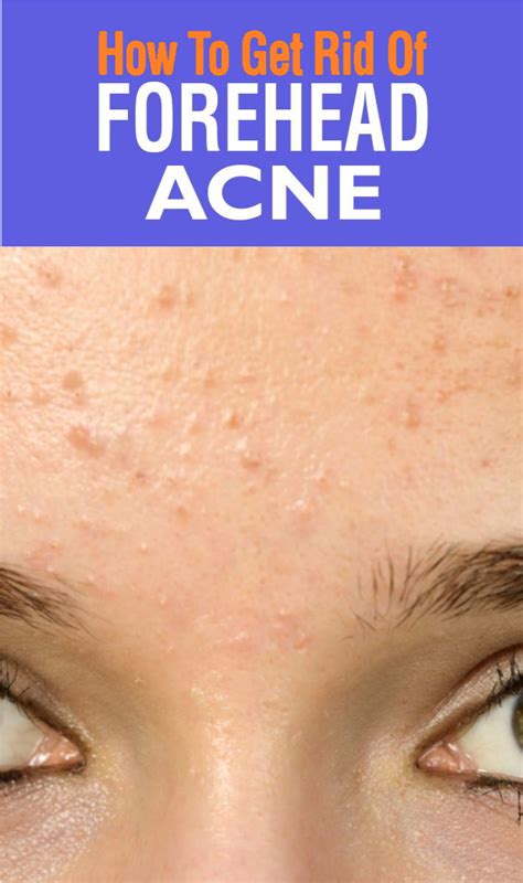 Forehead Acne: Causes, Treatment, And Prevention Tips - wellness magazine