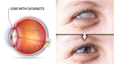 Cataract Symptoms