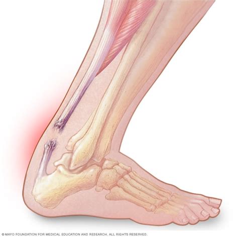 Achilles Tendon Rupture – Rupert Health Centre Inc Blog