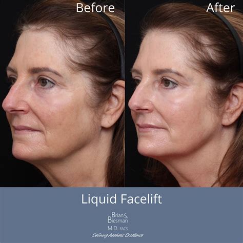 Liquid Face Lift - Brian Biesman MD