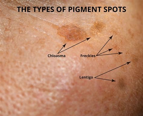 parmi Je ne sais ni lire ni écrire Aîné what causes brown spots on face ...