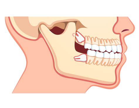 home remedies wisdom teeth ache