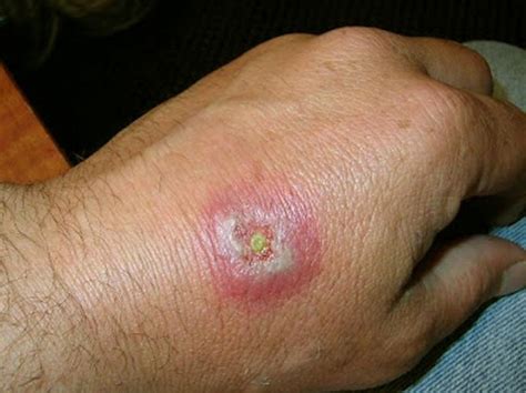 Pictures, Symptoms, and Treatment of Black Widow Spider Bites - YouMeMindBody