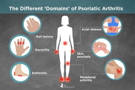 Different Types of Psoriatic Arthritis: Symptoms, Treatments, Outcomes