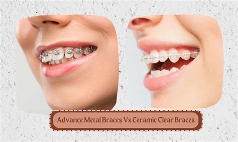 Advance Metal Braces Vs Ceramic Clear Braces