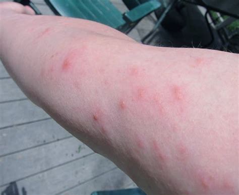 Poison Ivy Rash - Pictures, Treatment, Symptoms, Contagious, Duration