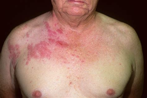 Shingles - Causes, Symptoms, Home Remedies, Treatment