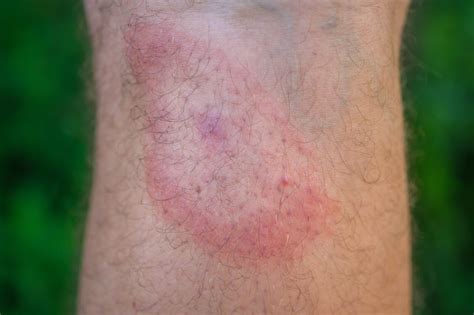 Tick Bite Symptoms | Outdoor Life