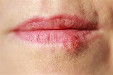 Mouth ulcers and cold sores: What’s the difference?