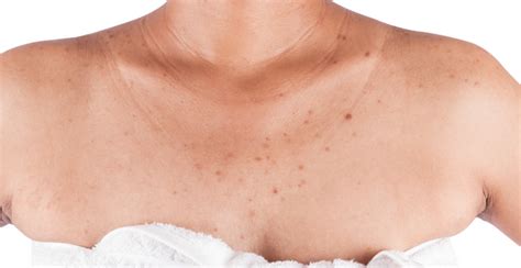 Chest Acne: Causes, Treatments, and Prevention | Clinikally