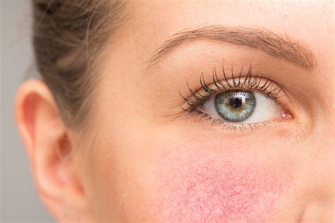 Rosacea: causes, symptoms, diagnosis & treatment - TeleMed2U