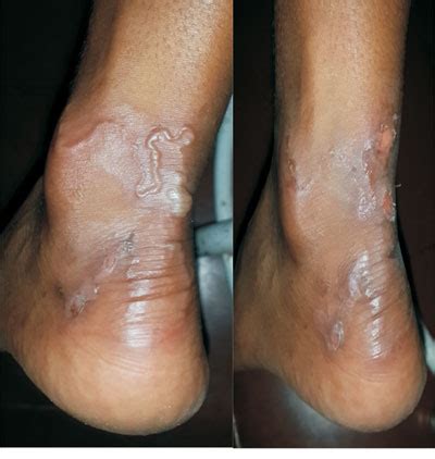 Cutaneous Larva Migrans Symptoms