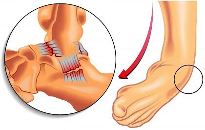 Twisted Ankle: Symptoms, Diagnosis & Treatment - Foot Pain Explored (2022)