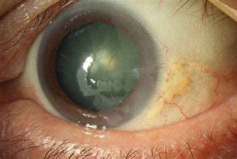 Prevalence of Ocular Surface Squamous Neoplasia Increases With Sun Exposure