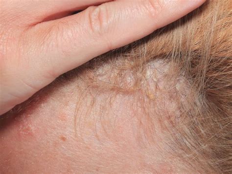 Scalp psoriasis: Symptoms, causes, and treatment