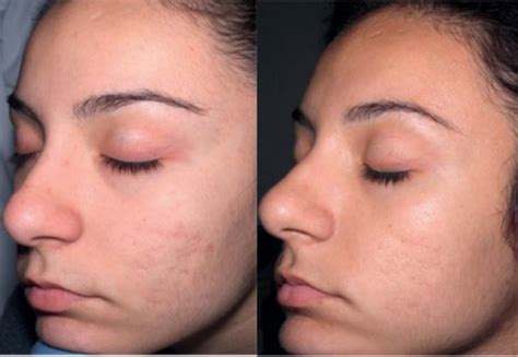 micro-needling-before-and-after-2