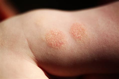 Eczema in Kids: What Parents Can Do to Calm the Itch