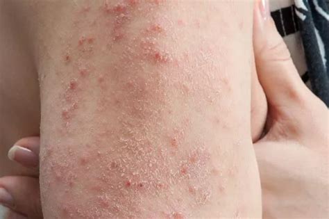 Symptoms of dengue fever to watch for amid spread fears after UK woman falls ill ...