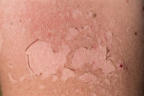 Sunburn or Sun Poisoning? Tell the Difference | UPMC