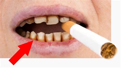 Can Orthodontist Tell If You Vape – SkinTots.com