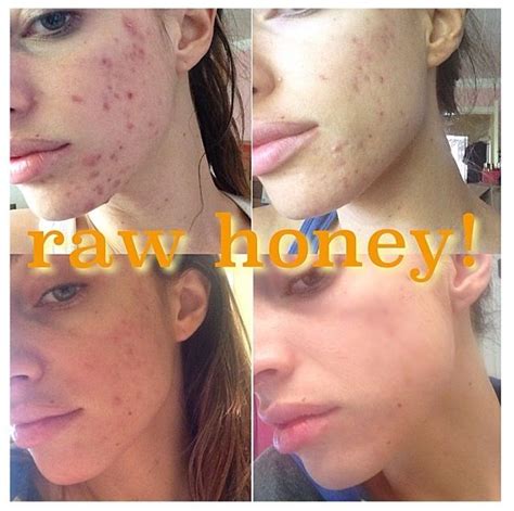 Results from a 100% raw honey face mask every night for 30 minutes for ...