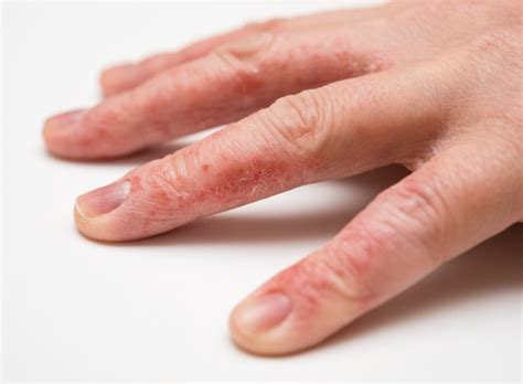 Hand Eczema | Dermatology Associates