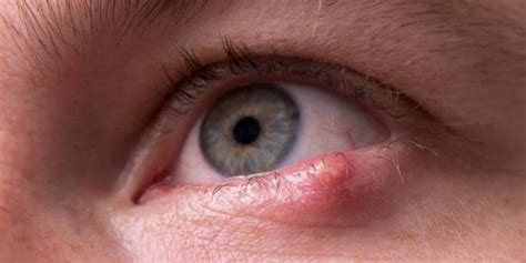 Home Remedies and Treatments for Styes: Causes, Symptoms, and Solutions - Archyde