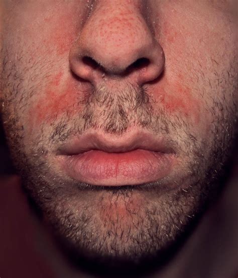 Seborrheic Dermatitis and Rosacea | Rosacea.org