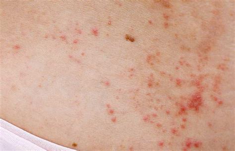 Heat Rash In Adults: Causes, Treatment, And Prevention Tips