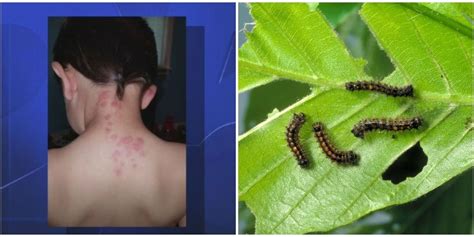 Gypsy Moth Caterpillars Are Causing Serious Skin Irritations - How to Treat Gypsy Moth ...