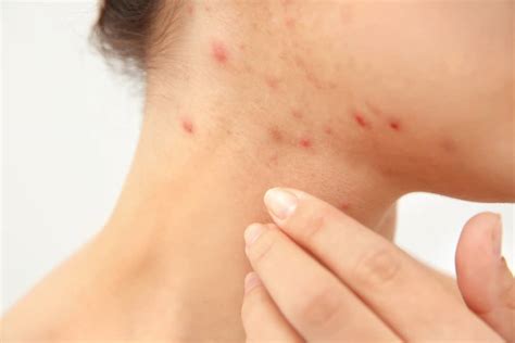 Scabies: Symptoms, Causes and Treatment - Natural Food Series