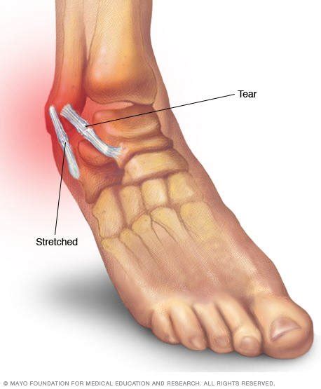 Tendonitis Of The Foot | Renew Physical Therapy