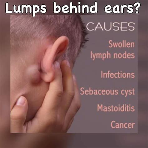 Swollen Lymph Nodes Behind Ear