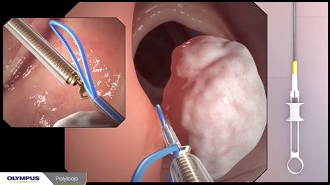 Colonoscopy with polypectomy procedure overview using Olympus devices - YouTube