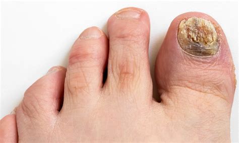 Types & Stages of Toenail Fungus | Premier Podiatry