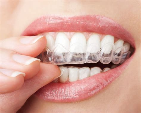 Invisalign Cleaning Tips - Dentists in Lansdale, PA