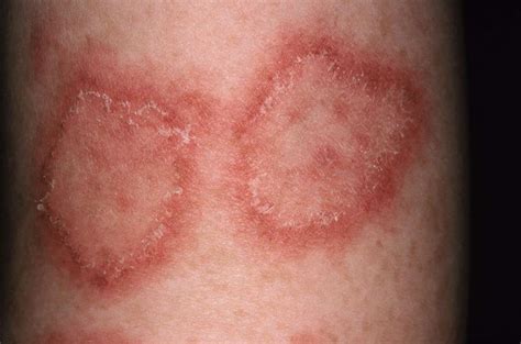 Images of 15 Common Skin Diseases in Adults