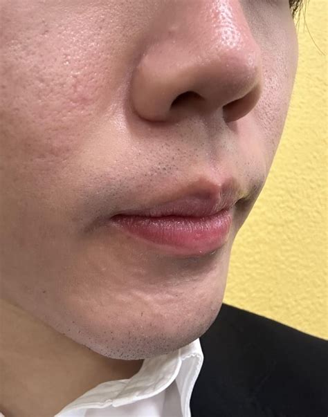 Information about bumps on chin? : r/AcneScars