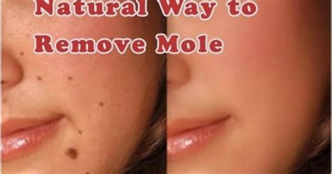 IAmJeni: Natural Mole Removal