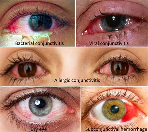 Causes and Precautions for Red Eyes- Know the Alert Signs - Drvarsha