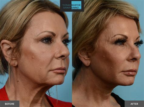 Facelift Before and After Photos Prove Just How Natural Today’s Results Look – TLKM Plastic Surgery