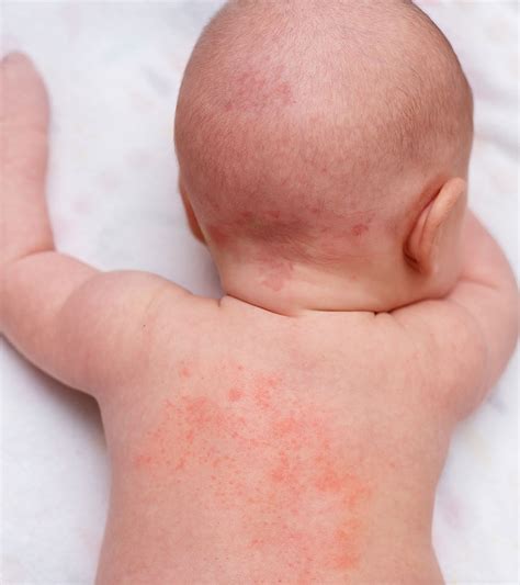 Baby Heat Rash: What Is It, Causes, And How To Prevent It