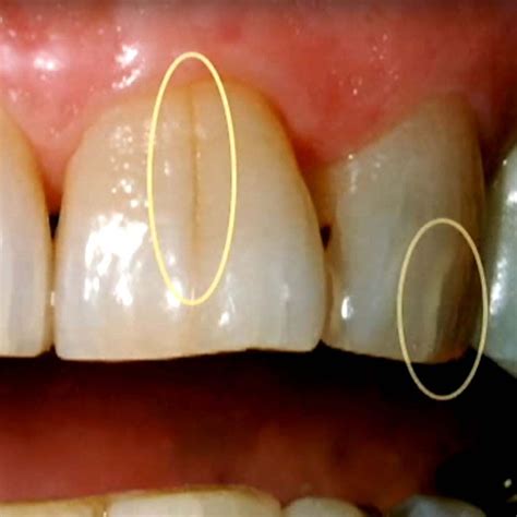 Tooth Fracture/Cracked Tooth: Causes, Diagnosis and Treatments