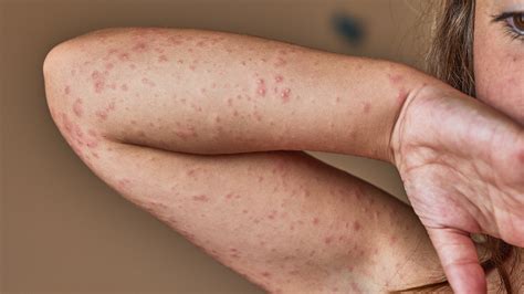 What Are Some Common Allergic Reactions to Antibiotics? - GoodRx