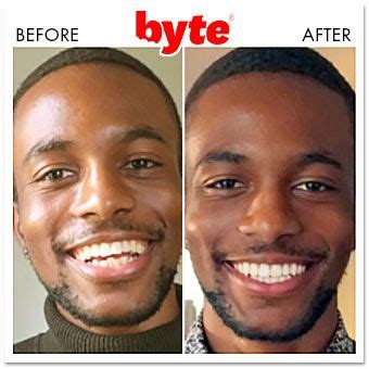 Byte Aligners: 21 Before & After Photos (Pics of Real Results!) | Byte, Teeth alignment, Before ...