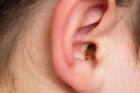 Why Do My Ears Feel Clogged? | Denver, Lone Tree, Castle Rock AOO | ENT Specialists of the Rockies