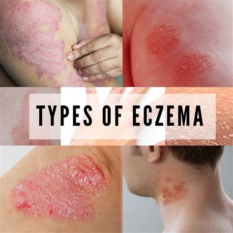 11 DIFFERENT TYPES OF ECZEMA: WHAT CAUSES AND RISK FACTORS OF ECZEMA ...