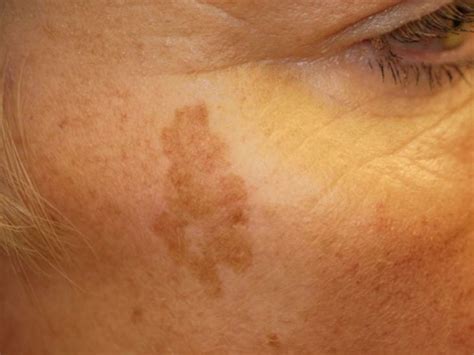 Flat Black Spot On Skin – Telegraph