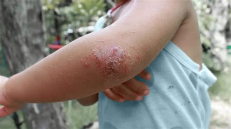 Eczema scars: Causes, treatment, and prevention